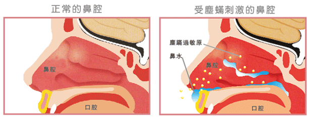 過敏性鼻炎鼻腔